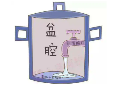 盆腔積液是怎麽回事？白帶91黄瓜视频下载廠家提醒早了解早預防