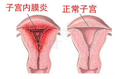 全自動陰道分泌物黄瓜视频免费下载廠家子宮內膜炎的症狀表現提前了解與預防