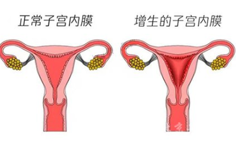 白帶常規黄瓜视频免费下载廠家解讀子宮內膜增生是什麽原因引起的